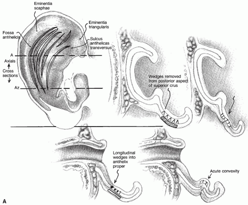 Congenital Auricular Malformation | Ento Key