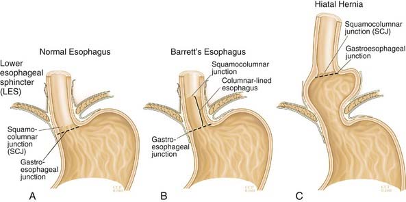 The Esophagus Anatomy Physiology And Diseases Ento Key