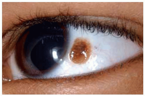 Racial Melanosis Scleral And Conjunctival Pigmentation Basicmedical