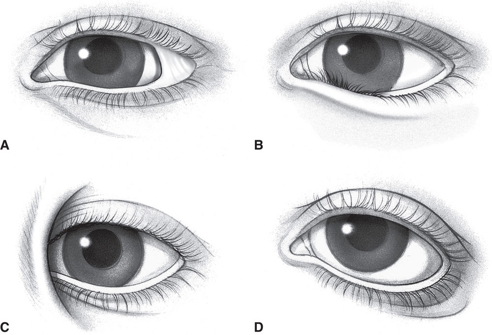 Classification And Management Of Eyelid Disorders Ento Key