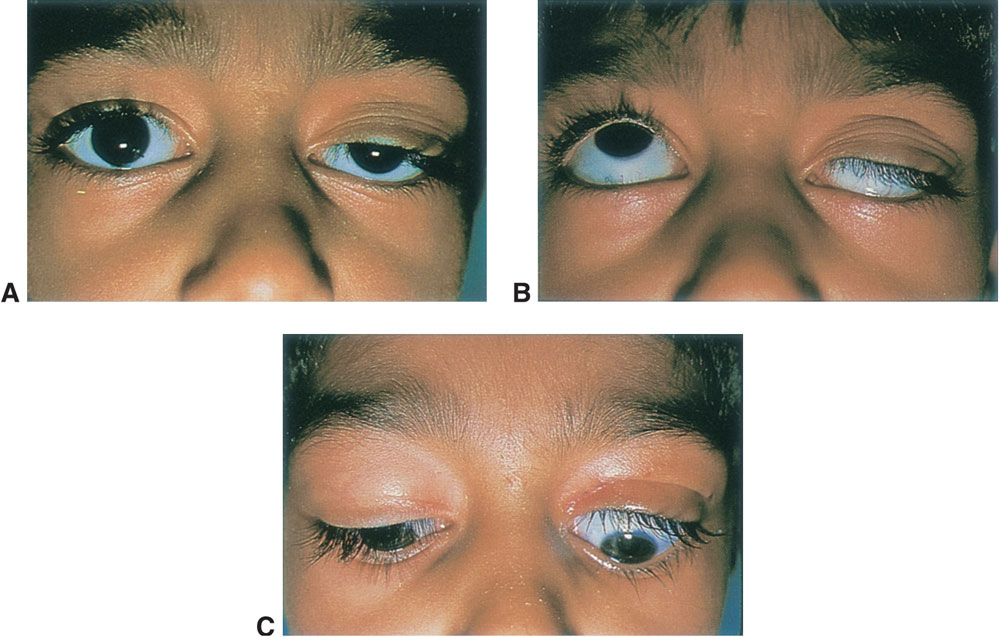 periocular-malpositions-and-involutional-changes-ento-key