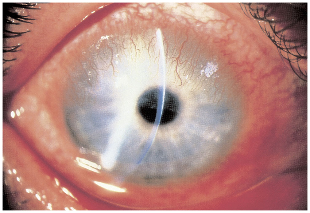 Clinical Approach To Ocular Surface Disorders | Ento Key