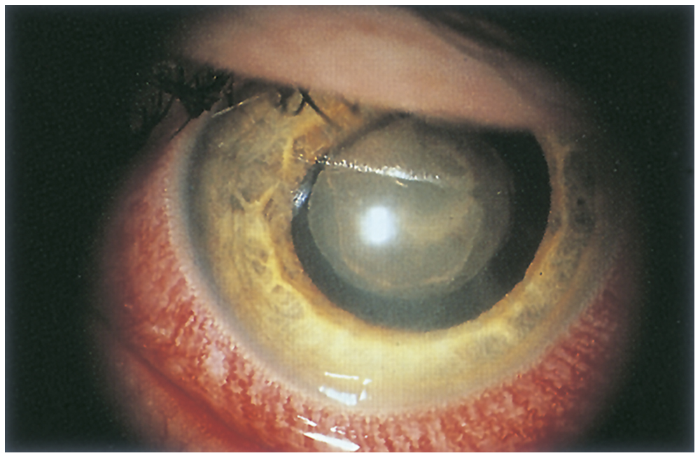 Noninfectious Ocular Inflammatory Diseases Ento Key