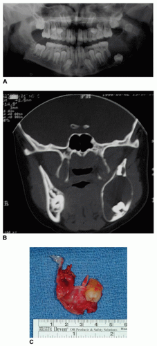 Odontogenic Cysts Tumors And Related Jaw Lesions Ento Key 6578