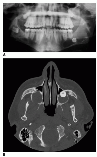 Odontogenic Cysts Tumors And Related Jaw Lesions Ento Key