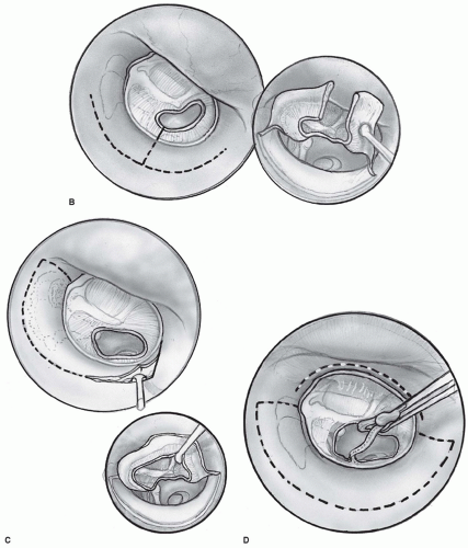 Tympanoplasty Ossicular Chain Reconstruction