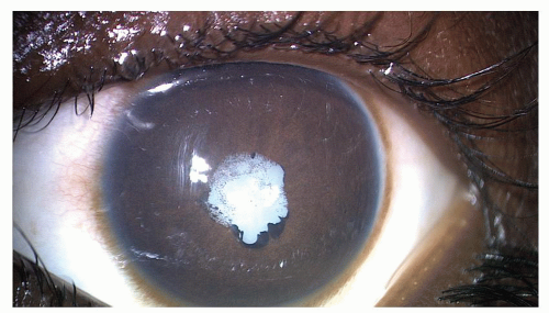 Pediatric Cataract Associated With Ocular And Systemic Anomalies | Ento Key