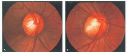 peripapillary staphyloma