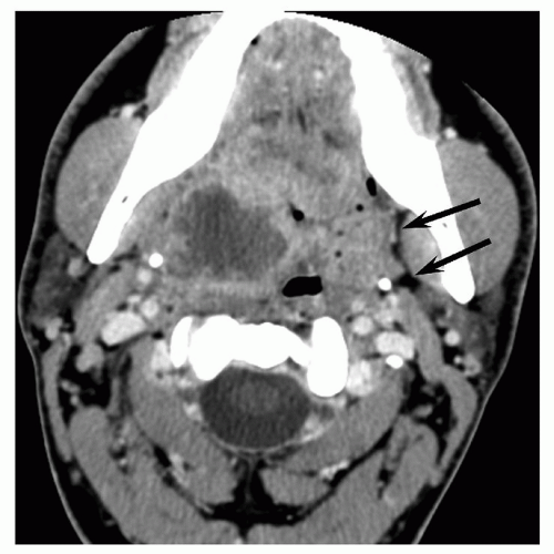 Deep Neck Infections | Ento Key