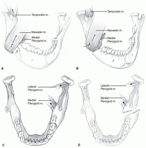 Newer Proposed Classification Of Mandibular Fractures - vrogue.co