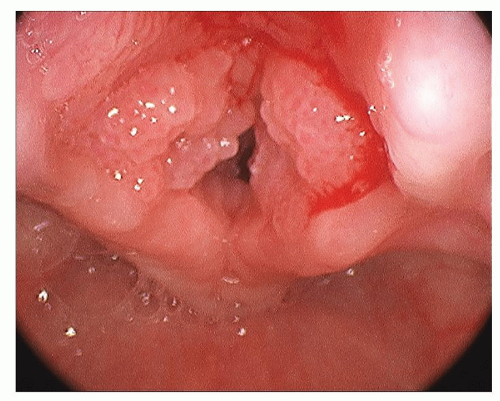 Respiratory papillomatosis newborn