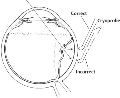 gas bubble detached retina
