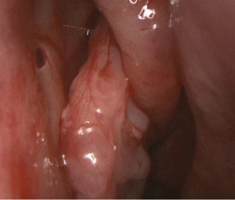 Laryngeal papillomatosis in adults, Laryngeal papillomatosis onset