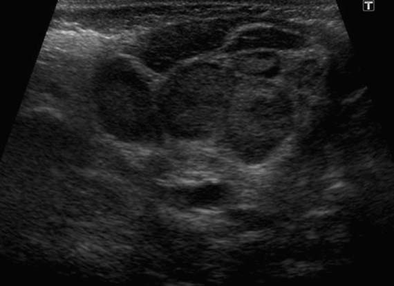 Cervical Lymphadenitis Ento Key