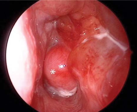 nasopharyngeal papilloma)