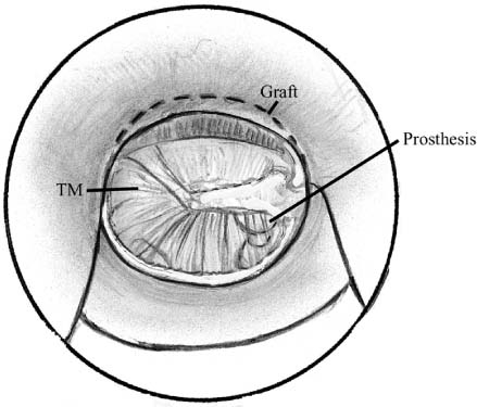 Over-Under Tympanoplasty: Indications And Technique | Ento Key