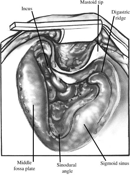 transmastoid-and-transcanal-labyrinthectomy-ento-key