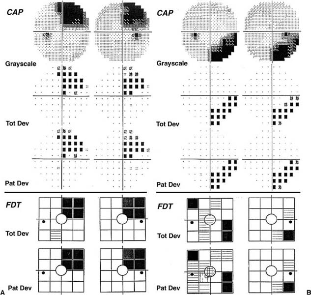 visual-fields-examination-of-the-left-eye-demonstrating-an-extended-download-scientific-diagram