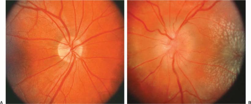 optic-disc-edema-ento-key