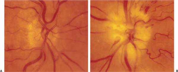 ischemic optic neuropathy