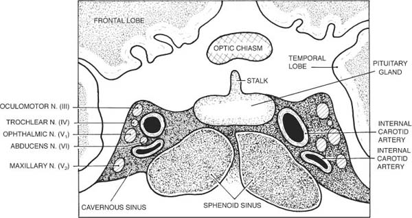 sphenoid sinus and cavernous sinus