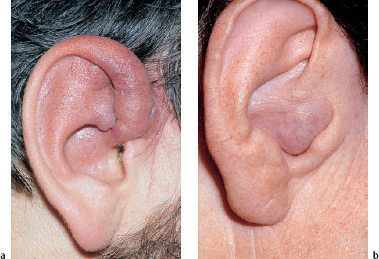 cancerous tumor behind ear