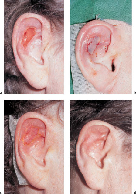 Sack like Growth in the ear Images