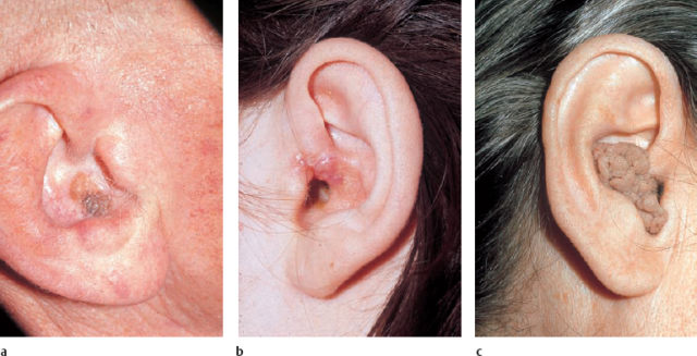 Sack like Growth in the ear Images