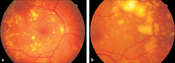 Yellow Spot Disease (Macular Degeneration) - Özel Karşıyaka Göz