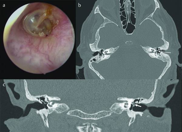 Radiological Considerations for Endoscopic Middle Ear Surgery | Ento Key