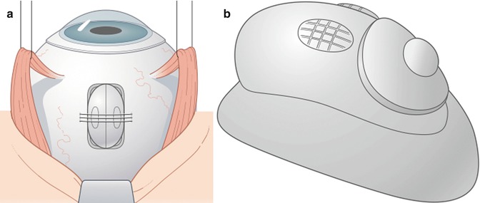 A314008_2_En_9_Fig1_HTML.jpg