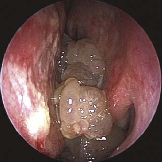 inverted papilloma endoscopic removal)