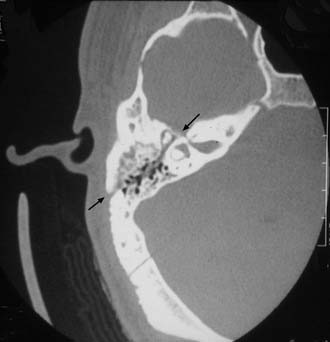 Management of Temporal Bone Trauma Ento Key