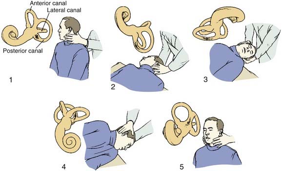 Epley Maneuver Left Ear Vertigo The Clinical Advisor