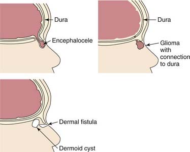 dermoid cyst bridge of nose