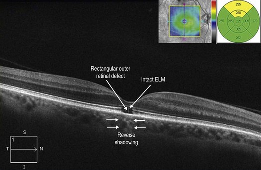 Retinal Light Toxicity (Photochemical) | Ento Key