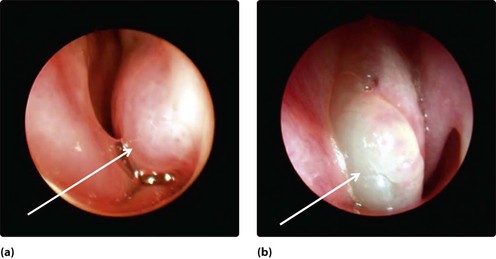 pale nasal turbinates