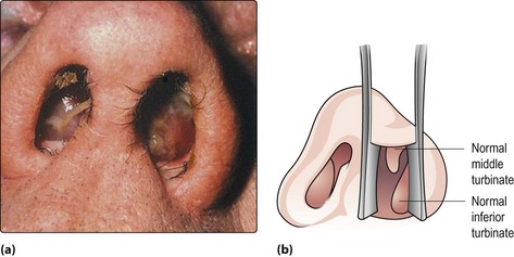 bilateral nasal polyps