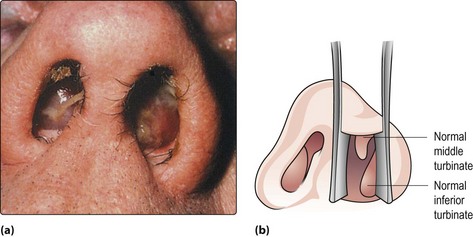 bilateral nasal polypectomy