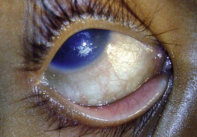 Conjunctival Xerosis Meaning