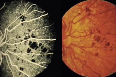 Congenital And Vascular Retinal Abnormalities Ento Key