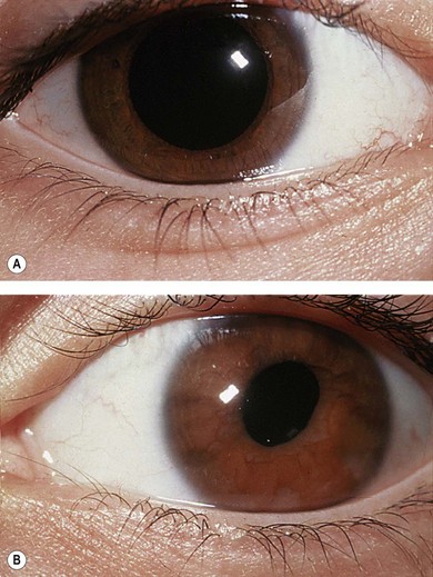 abnormal pupil reaction to light