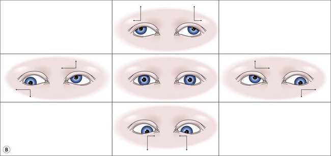 A V And Other Strabismus Patterns Ento Key