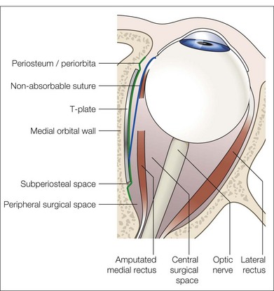 Strabismus Surgery | Ento Key