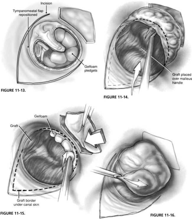 Tympanoplasty-Undersurface Graft Technique: Transcanal Approach | Ento Key