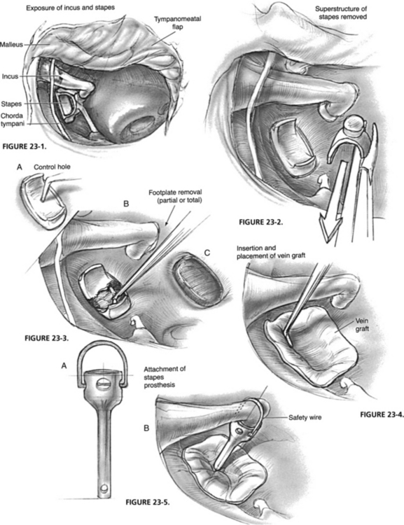 Stapedectomy of the Stapes of the Ear - Labelled – Medical Stock