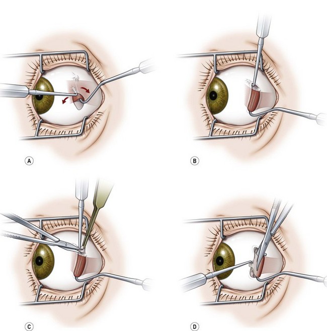 Strabismus Surgery Ento Key 