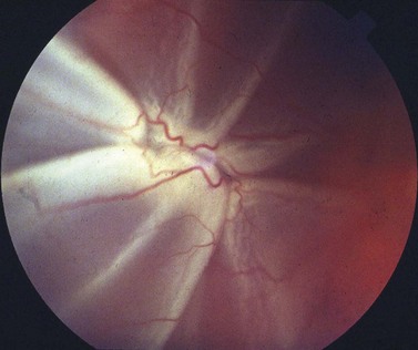 Retinal Detachment And PVR | Ento Key