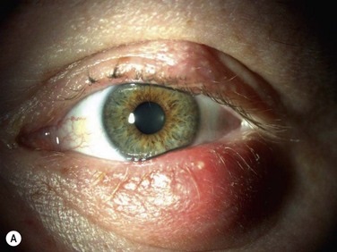 meibomian gland obstruction