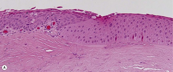 pterygium histology